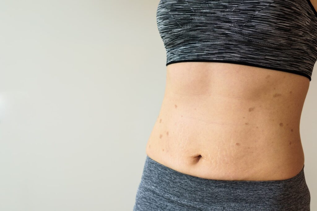 Gastric Sleeve Surgery Scars – What to Expect & Aftercare