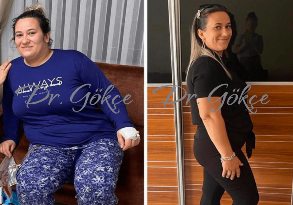 Gastric Sleeve before and after