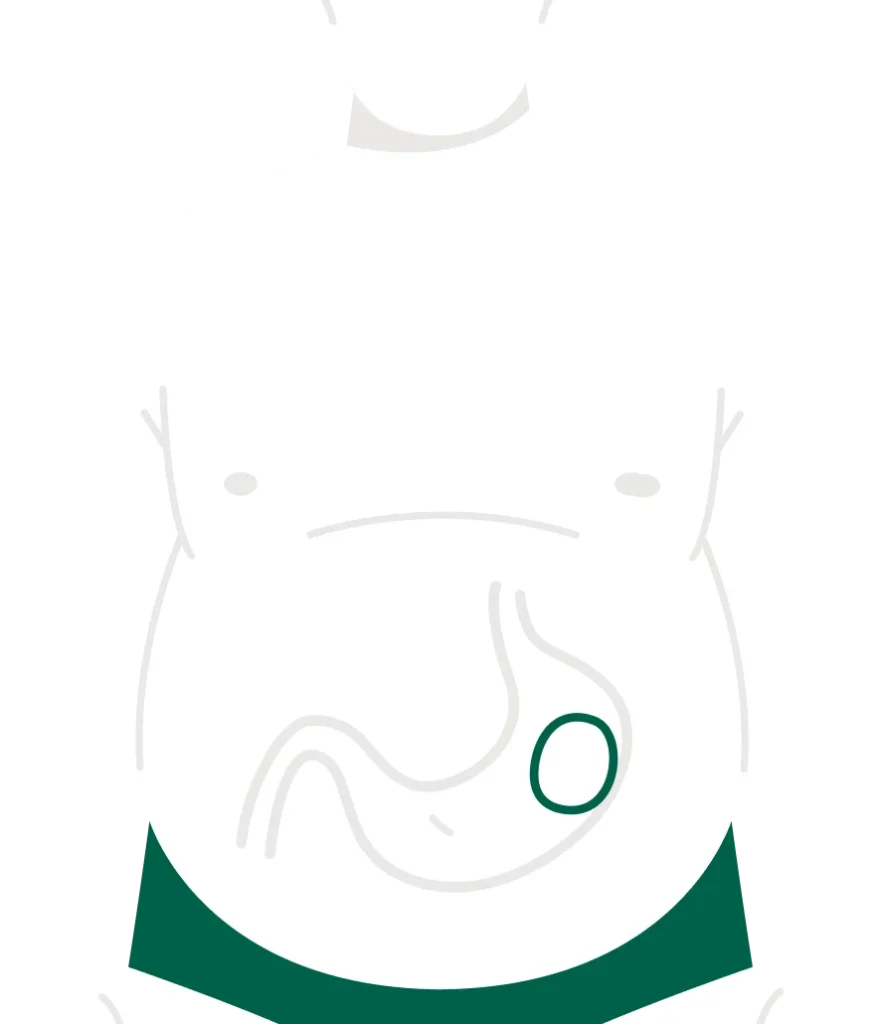 Gastric balloon treatment in Turkey by Dr. Gökçe